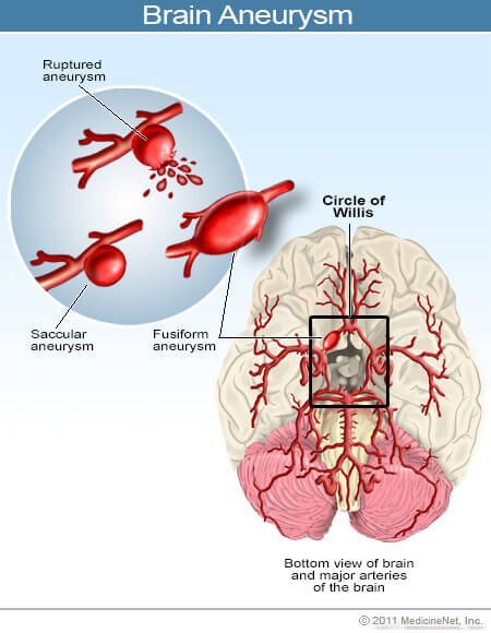 Cerebral Aneurysm