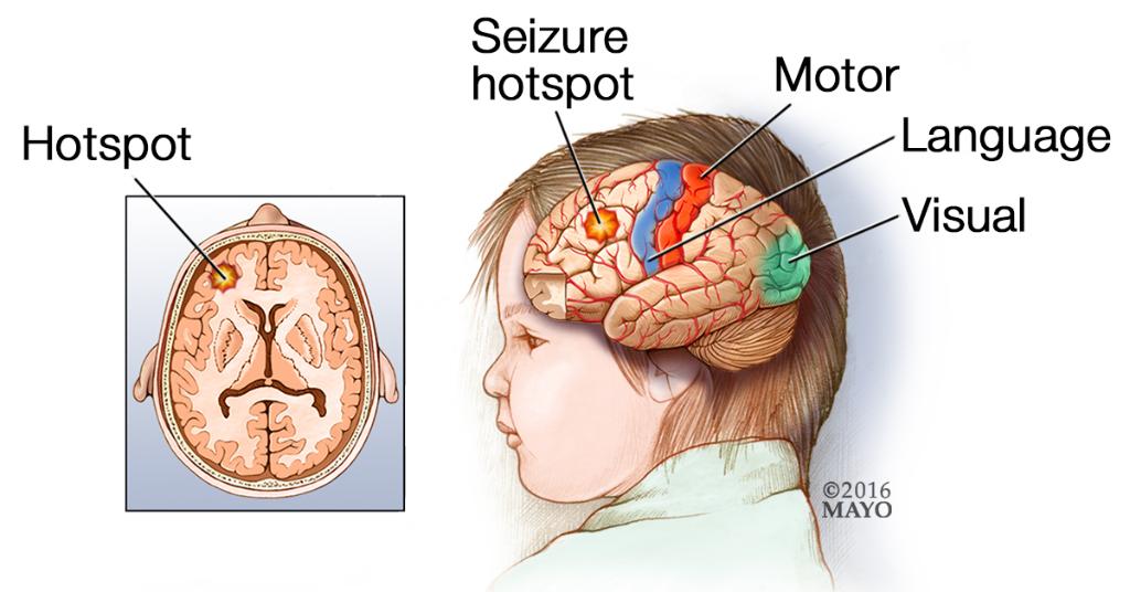 Epilepsy and Seizures