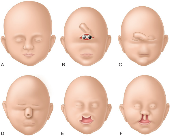 Holoprosencephaly